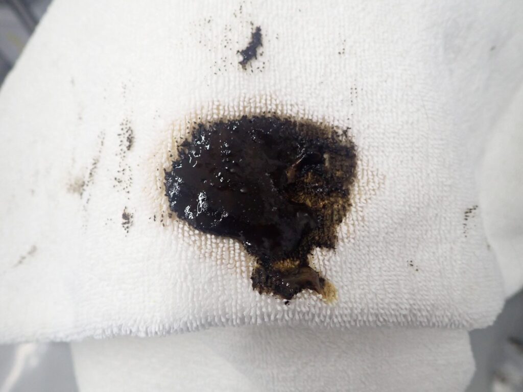 アルコールによる腎臓障害の兆候は何ですか?