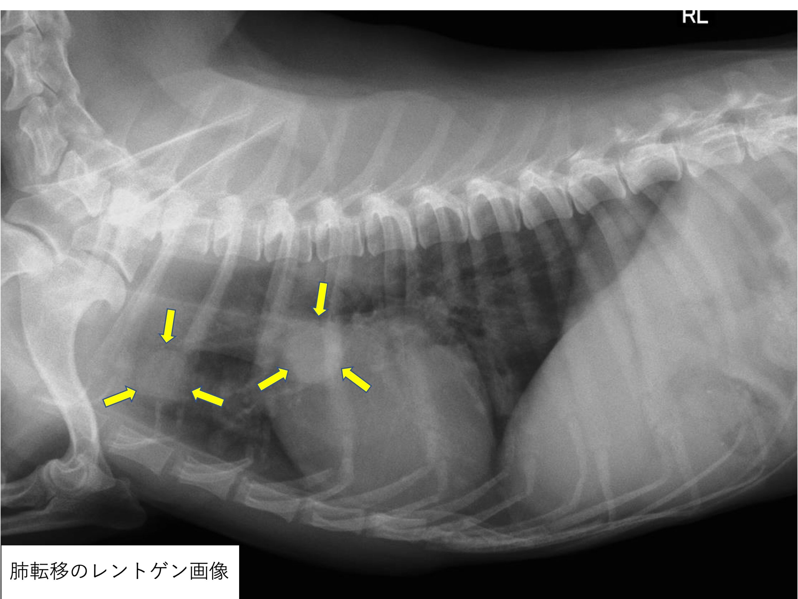 肺に転移した甲状腺がんの予後はどうなりますか?