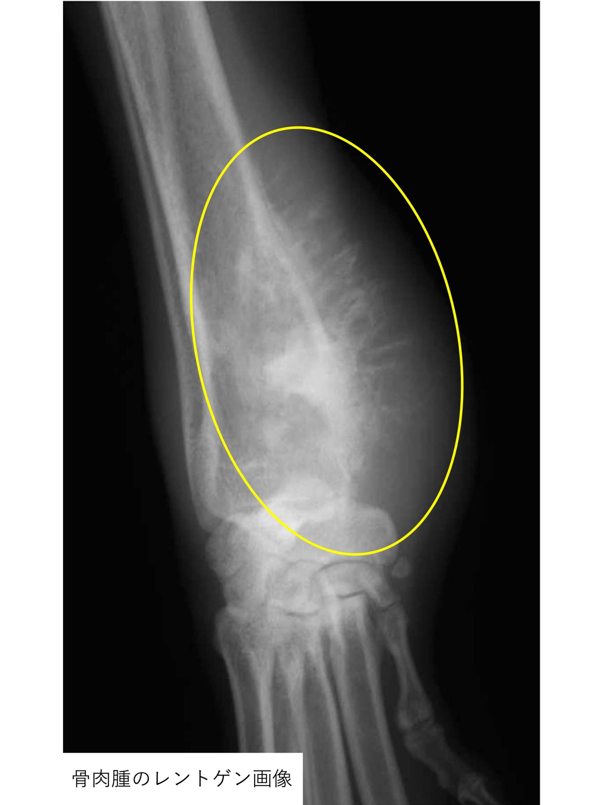 犬 の 骨 肉腫 余命